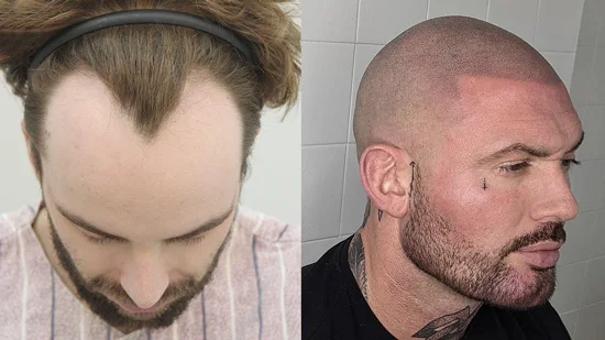 Difference Between Widows Peak and Receding Hairline